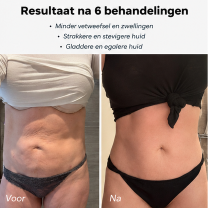 Vitalora CuppaRelief™  Spa-behandeling Thuis – Cellulite Cupping Massager