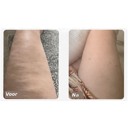 Vitalora CuppaRelief™  Spa-behandeling Thuis – Cellulite Cupping Massager